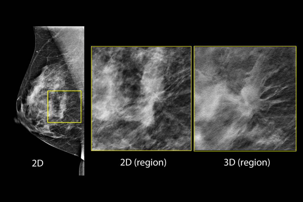 疑わしい病変が見られる乳房検査の臨床画像
