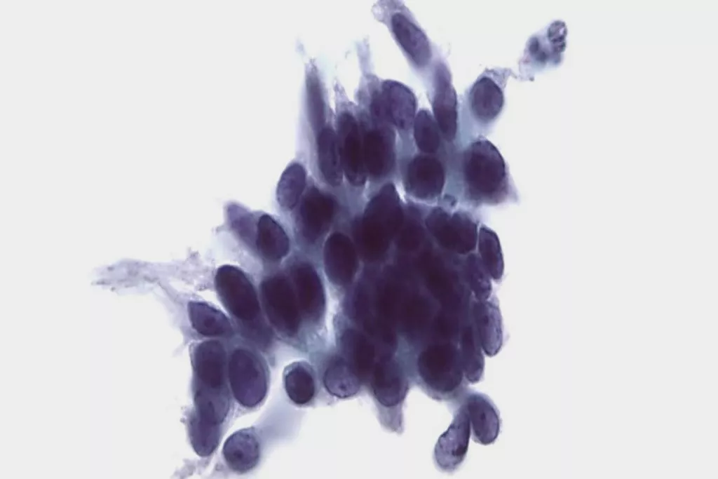 子宮頸部腺上皮内腫瘍のパップテストスキャン