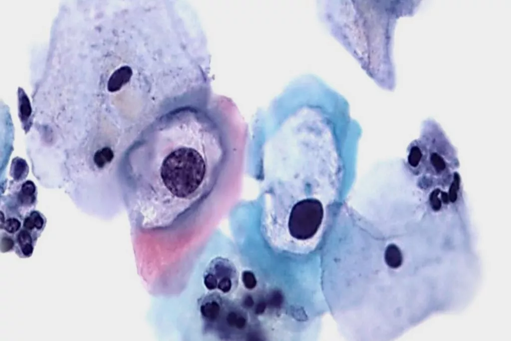 HPV による軽度異核症のパップテストスキャン