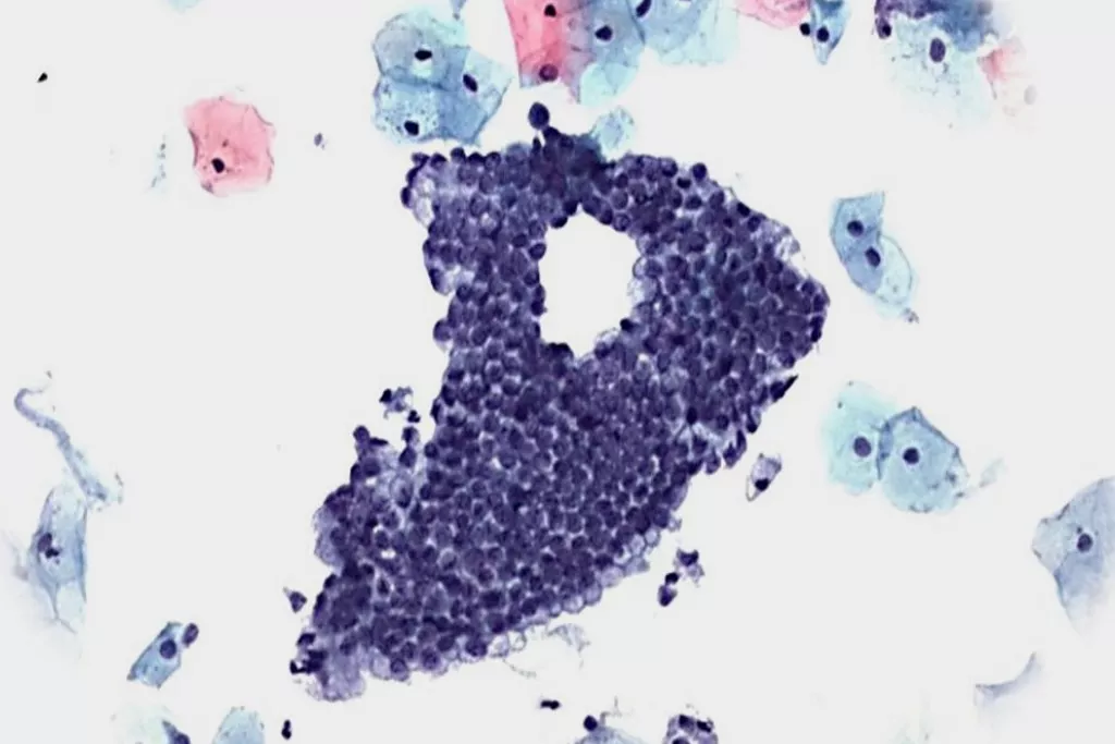 子宮頸管細胞でパップテストスキャン陰性