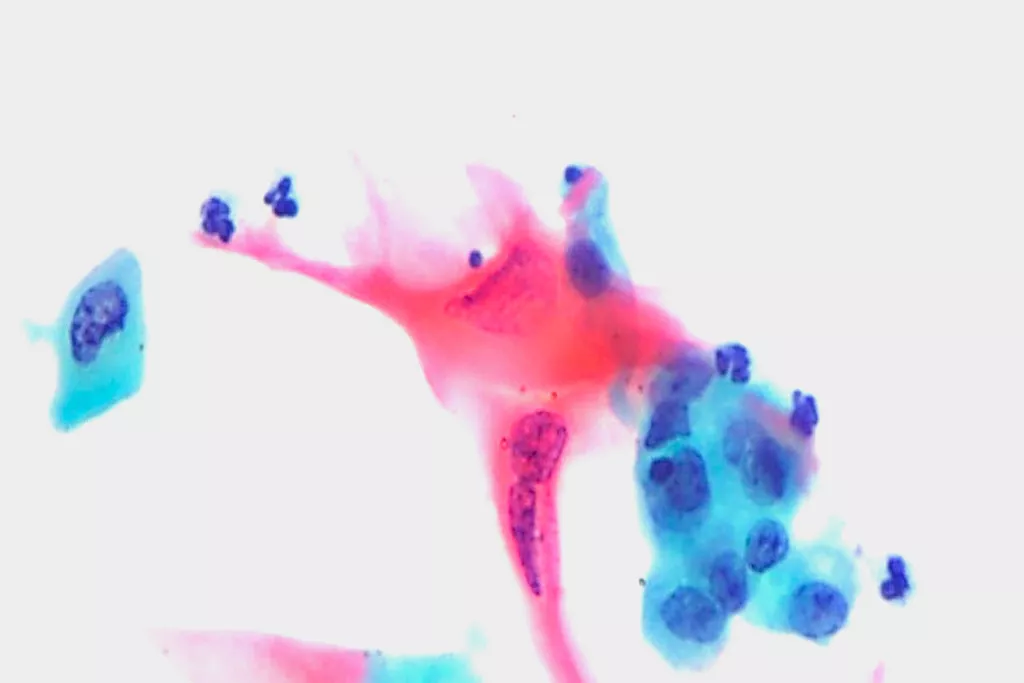 扁平がん腫、尿、パパニコロウ染色