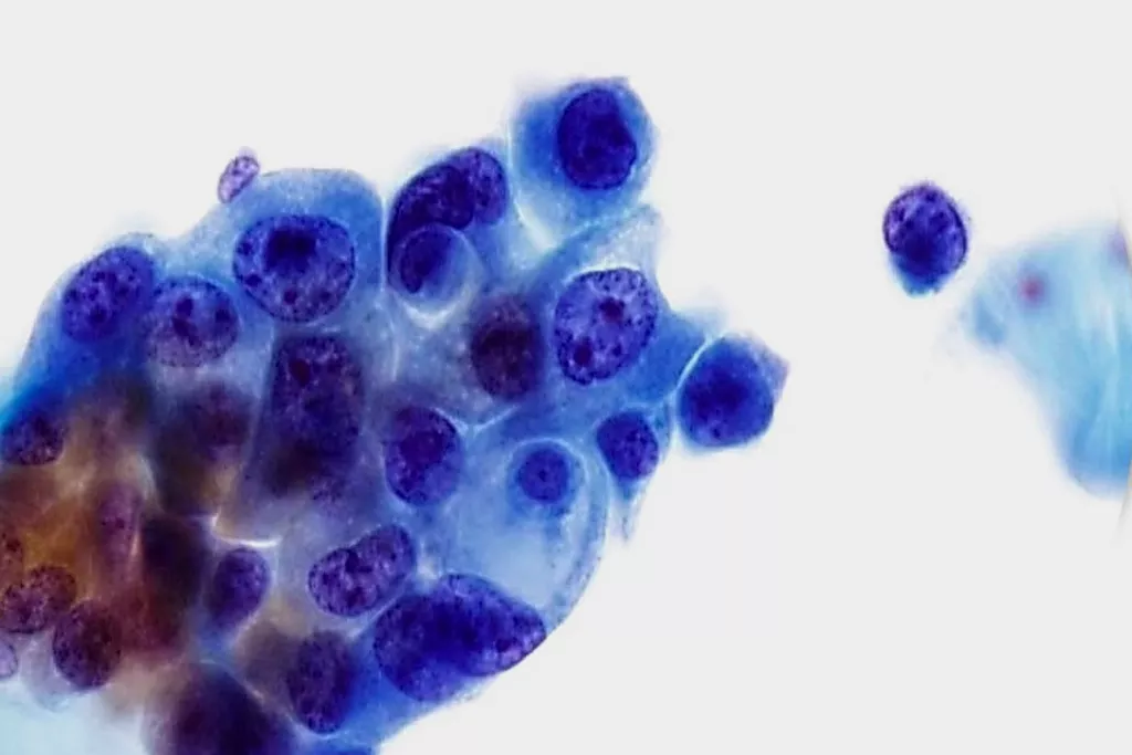 移行上皮癌、グレード 3、尿、パパニコロウ染色